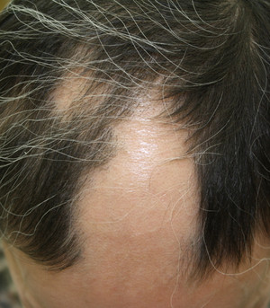 えぬくりブログ 円形脱毛症の新しい治療６ 経過写真