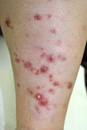 えぬくりブログ: 慢性痒疹のナローバンドUVB療法